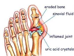 Illustration of gout 
Epsom Salt therapy for gout